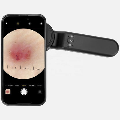 IBOOLO DE-4100 New Diagnostic Dermatoscope Optical 10x zoom dermatoscope, The world's most trusted hand-held dermatoscope - My Store