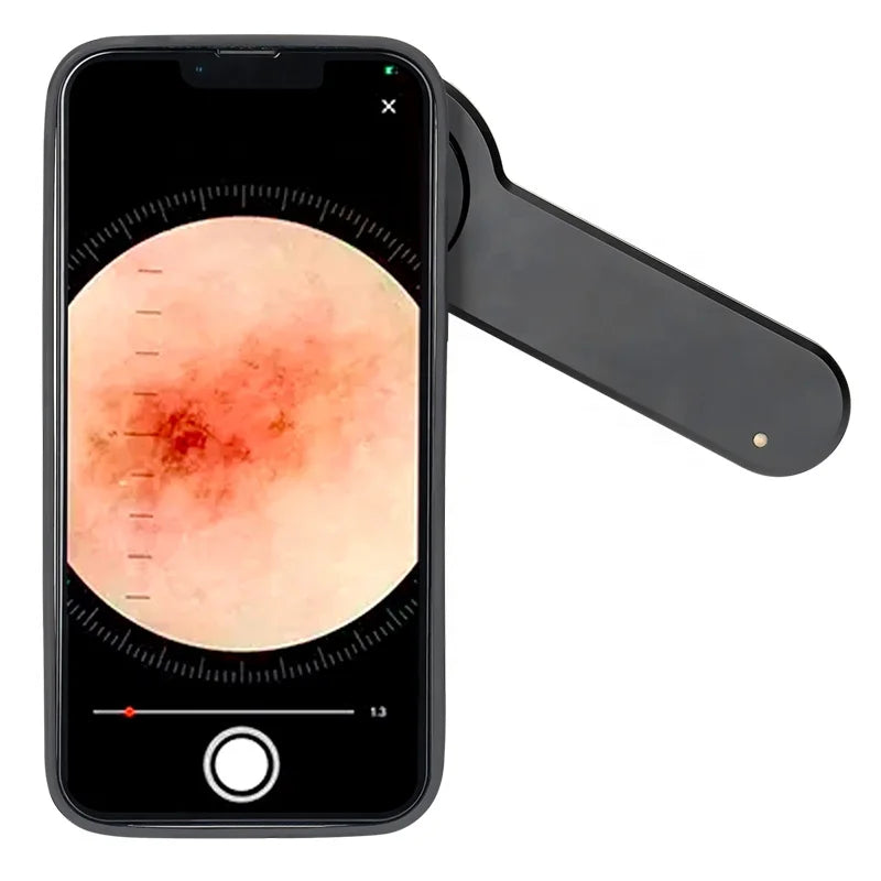IBOOLO DE-3100 Best Professional optical dermatoscope dermoscope , the best handheld dermatoscope in the world - My Store